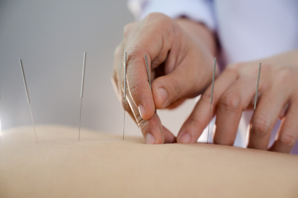 Detalhe de uma mão de um acupunturista inserindo agulhas nas costas de um paciente.